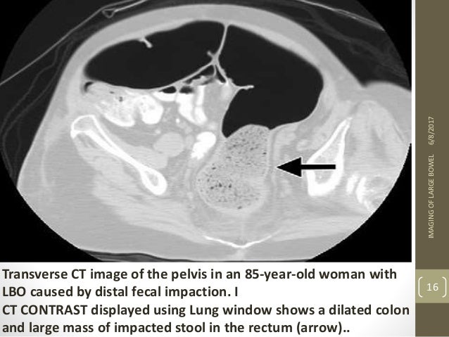 ct scan anus colon Porn sex extreme real